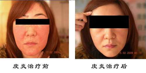 面部皮肤治疗+特色项目:善长治疗激素性皮炎